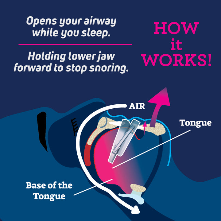 SmartGuard Anti-Snore Device – SmartGuard RX